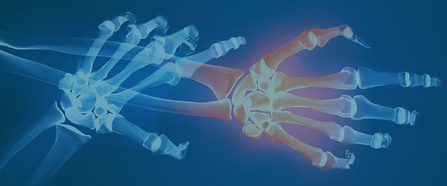 изображение ревматоидного артрита кисти рук
